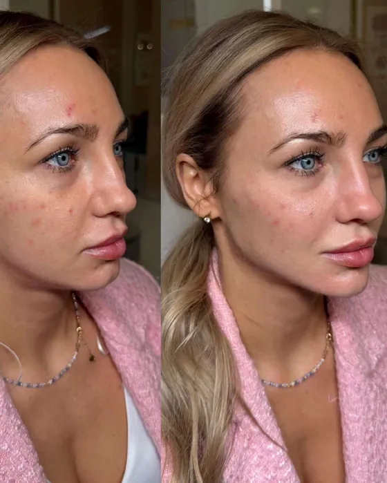 Mezoterapia igłowa Piła — efekt przed i po, Beauty Station, Justyna