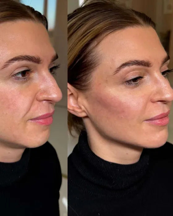 Radiofrekwencja mikroigłowa Piła — efekt zabiegu, Beauty Station